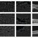 Fig. 4 Da sinistra a destra angiogrammi OCT del plesso superficie, profondo e coriocapillare e OCT strutturale di 3 bambini affetti da malattia di Leber Coats.