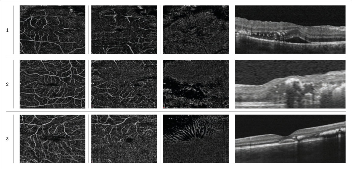 Fig. 4 Da sinistra a destra angiogrammi OCT del plesso superficie, profondo e coriocapillare e OCT strutturale di 3 bambini affetti da malattia di Leber Coats.