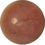 Fig. 3 Retinografia dell’occhio sinistro di un paziente affetto da malattia di Behçet, caratterizzata da vasi atresici, area pigmentata perifoveale, pallore papillare ed addensamenti vitreali.