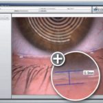 Fig. 4 THM con il Keratograph M5.