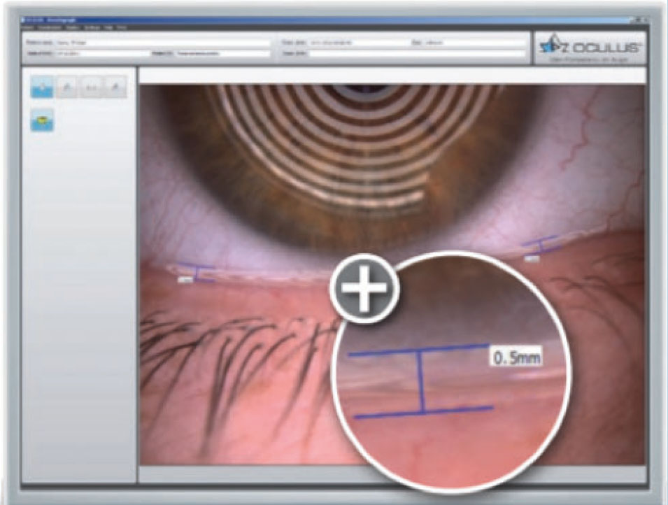 Fig. 4 THM con il Keratograph M5.