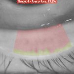 Fig. 4A Meibomiografia in luce infrarossa che consente di misurare l’area di perdita di funzionalità delle ghiandole di Meibomio.