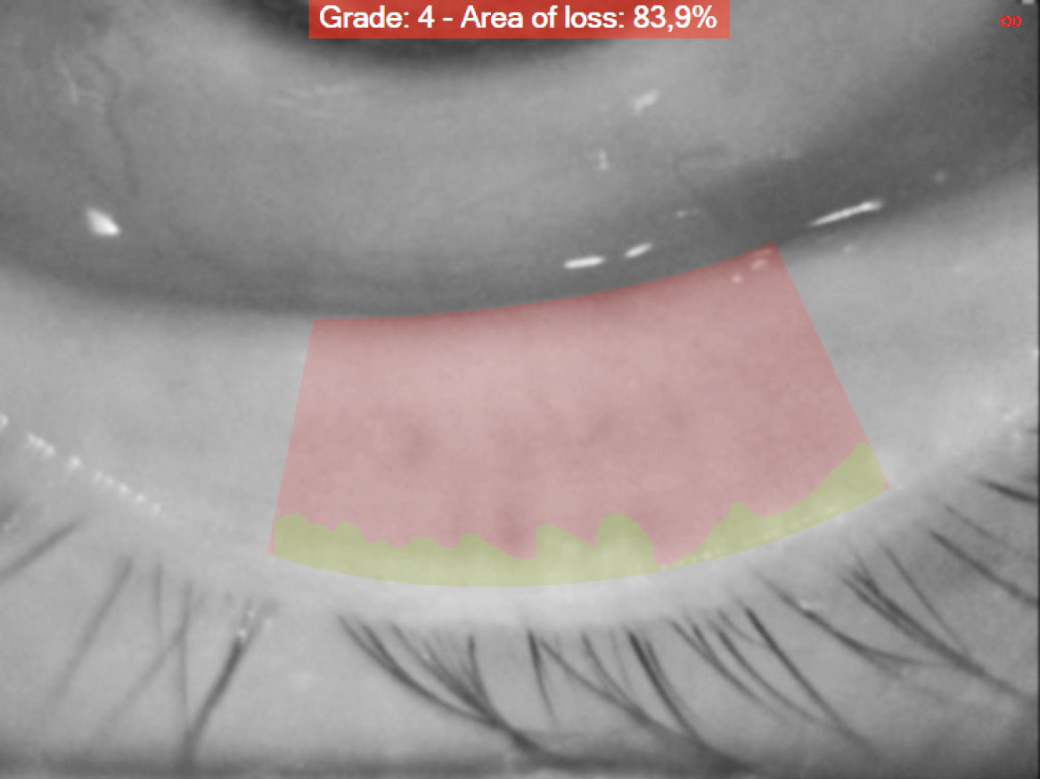 Fig. 4A Meibomiografia in luce infrarossa che consente di misurare l'area di perdita di funzionalità delle ghiandole di Meibomio.