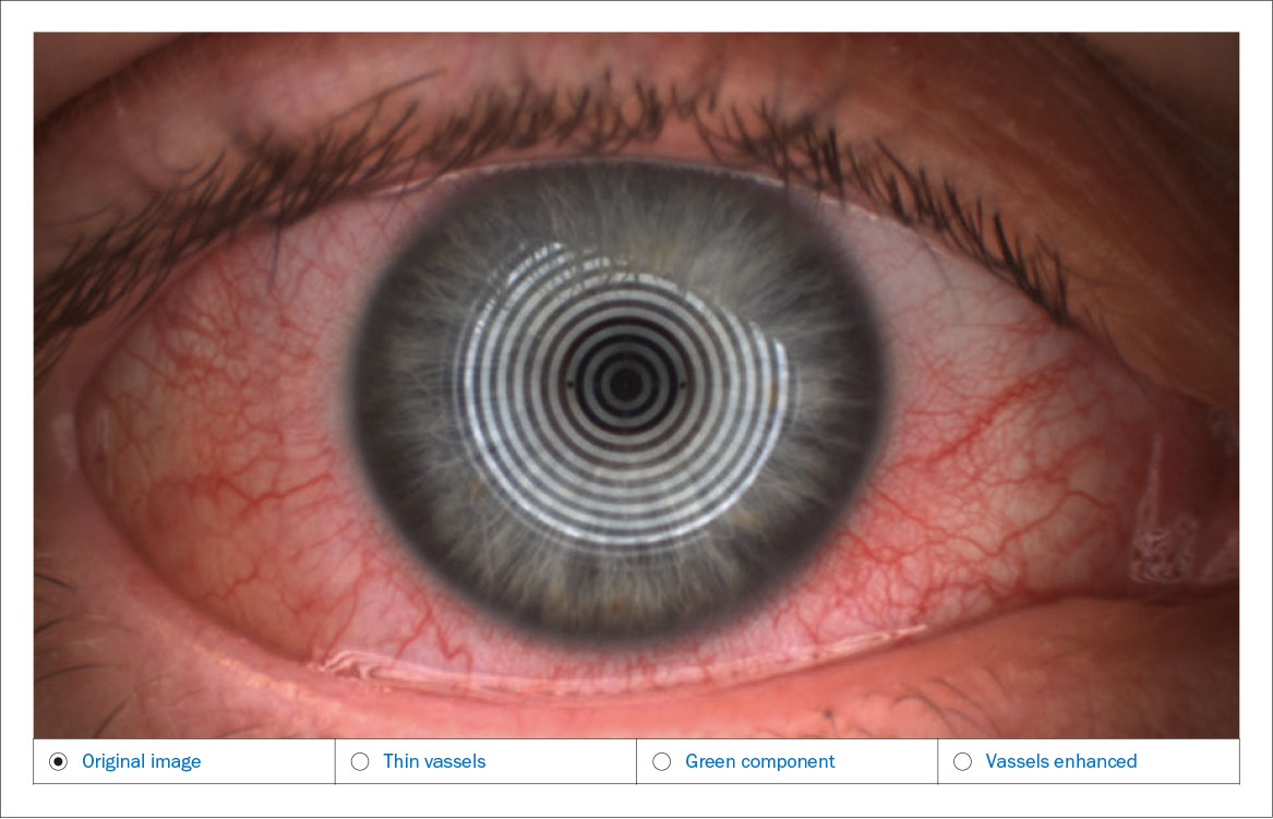 Fig. 4A Valutazione automatizzata della bulbar redness (arrossamento congiuntivale bulbare), eseguita con il Keratograph 5M (Oculus).