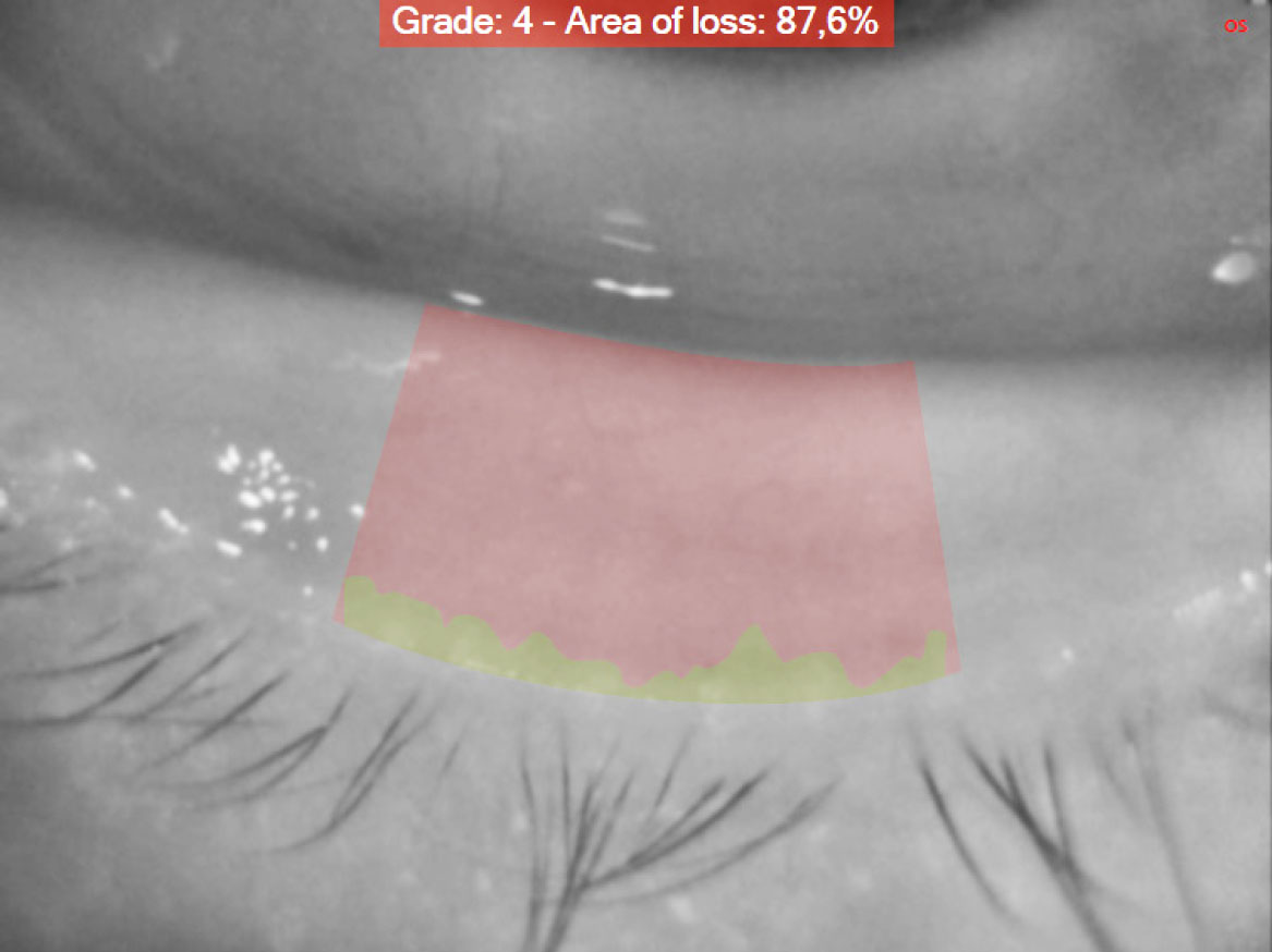 Fig. 4B Meibomiografia in luce infrarossa che consente di misurare l'area di perdita di funzionalità delle ghiandole di Meibomio.