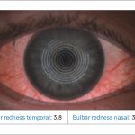 Fig. 4B Valutazione automatizzata della bulbar redness (arrossamento congiuntivale bulbare), eseguita con il Keratograph 5M (Oculus).
