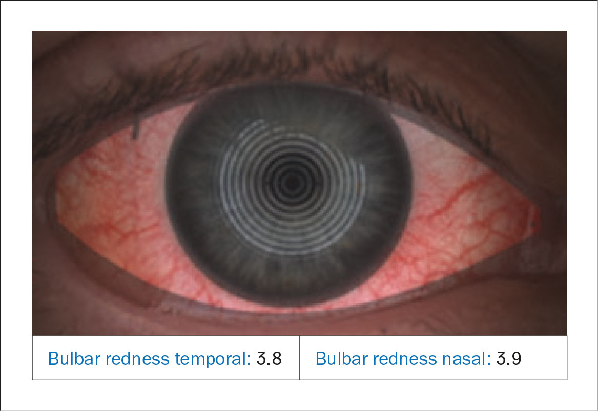 Fig. 4B Valutazione automatizzata della bulbar redness (arrossamento congiuntivale bulbare), eseguita con il Keratograph 5M (Oculus).