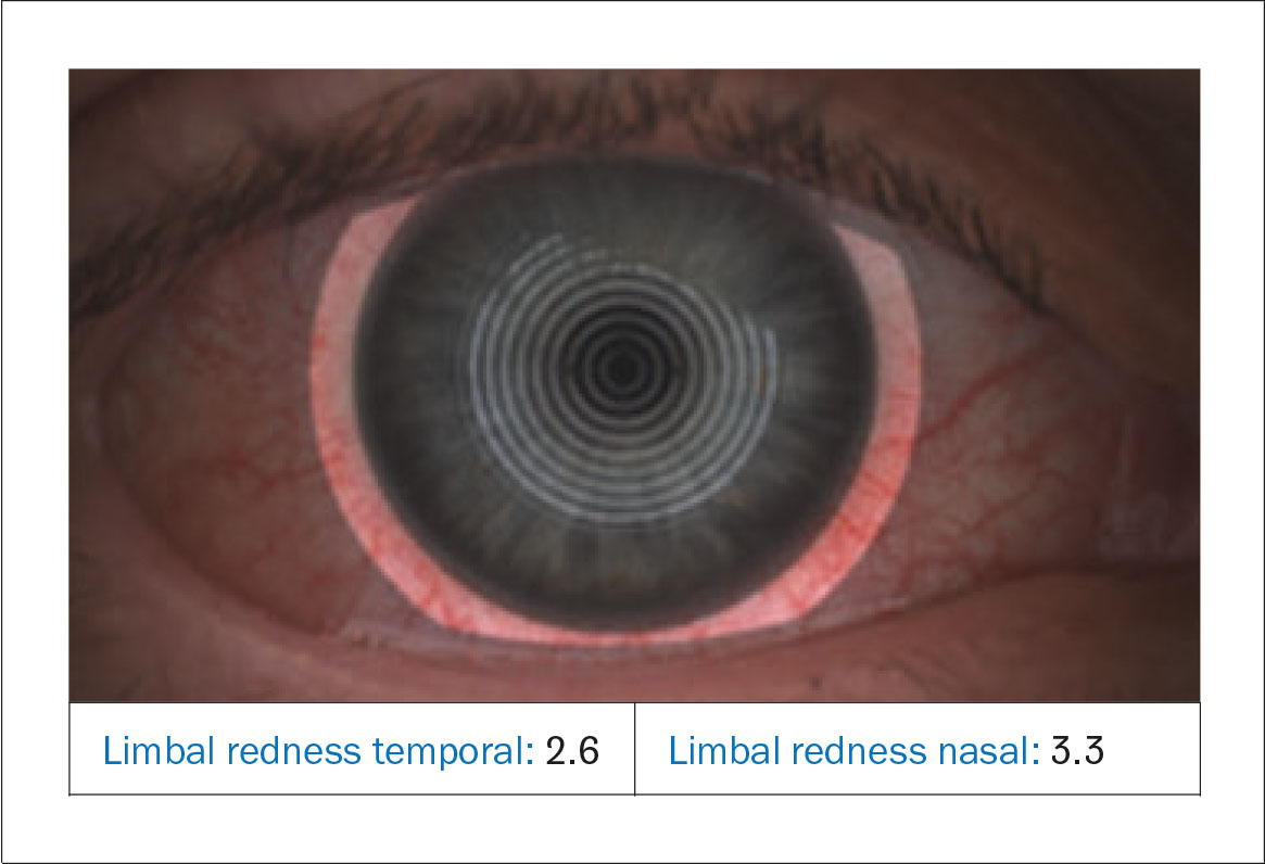 Fig. 4C Valutazione automatizzata della bulbar redness (arrossamento congiuntivale bulbare), eseguita con il Keratograph 5M (Oculus).