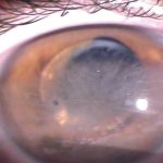 Fig. 4 Immagine del segmento anteriore di un paziente con complicanze oculari, evidenziando lussazione anteriore della IOL, cheratopatia a bandelletta.