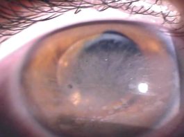 Fig. 4 Immagine del segmento anteriore di un paziente con complicanze oculari, evidenziando lussazione anteriore della IOL, cheratopatia a bandelletta.