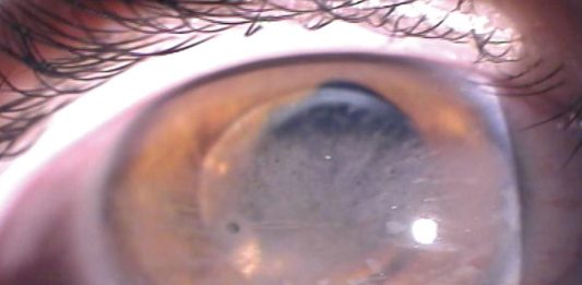 Focus sulle uveiti pediatriche Fig. 4 Immagine del segmento anteriore di un paziente con complicanze oculari, evidenziando lussazione anteriore della IOL, cheratopatia a bandelletta.