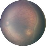 Fig. 5A Esame Ret-cam di un bambino affetto da ROP.