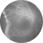 Fig. 5B Esame FAG di un bambino affetto da ROP.