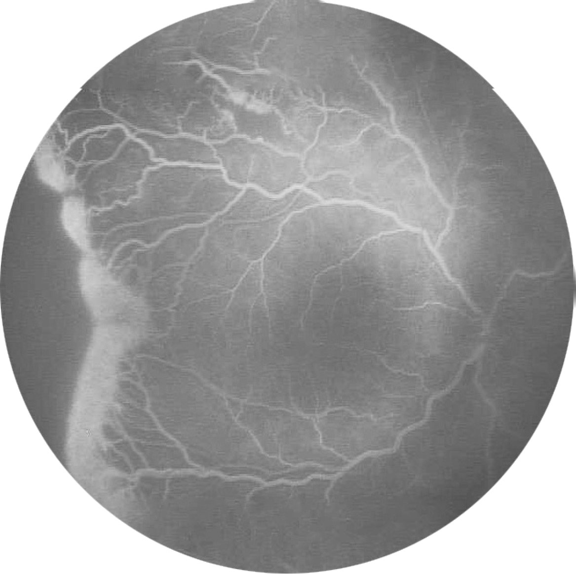 Fig. 5B Esame FAG di un bambino affetto da ROP.