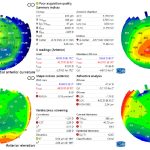 Fig. 5 Topografia che mostra una profonda asimmetria lungo dall’asse verticale nei raggi di curvatura, pachimetria ed elevazione anteriore. L’analisi refrattiva misura un astigmatismo di -5.11 D, la causa dello sdoppiamento verticale dell’immagine.