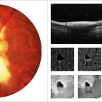 Fig. 6 Foto fundus, OCT strutturale e OCT-angiografia di un bambino di 7 anni affetto da anisometropia, fibre mieliniche del NO e strabismo divergente.