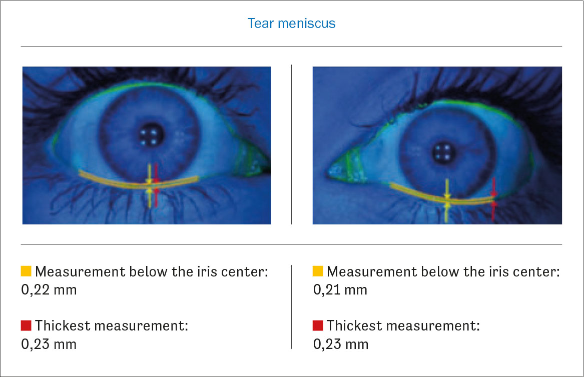 Fig. 6 THM con il Tear Check.