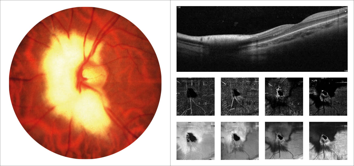 Fig. 6 Foto fundus, OCT strutturale e OCT-angiografia di un bambino di 7 anni affetto da anisometropia, fibre mieliniche del NO e strabismo divergente.