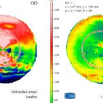 Fig. 6 Confronto dell’aberrometria a distanza di 1 anno. Si nota la drastica riduzione delle HOA e il ripristino di una regolarità dell’errore refrattivo in tutto il campo pupillare.