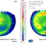 Fig. 7 Confronto delle topografie a distanza di un anno. Regolarizzazione delle curvature corneali, della pachimetria e miglioramento significativo dell’analisi refrattiva del cyl.