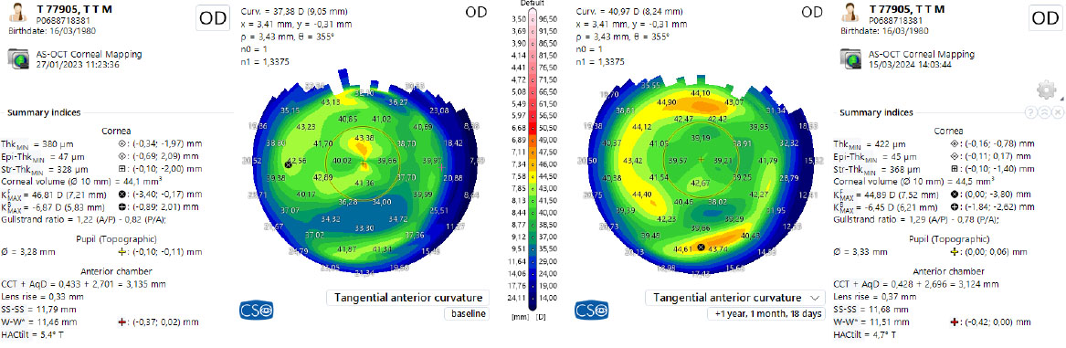 Fig. 7 Confronto delle topografie a distanza di un anno. Regolarizzazione delle curvature corneali, della pachimetria e miglioramento significativo dell’analisi refrattiva del cyl.