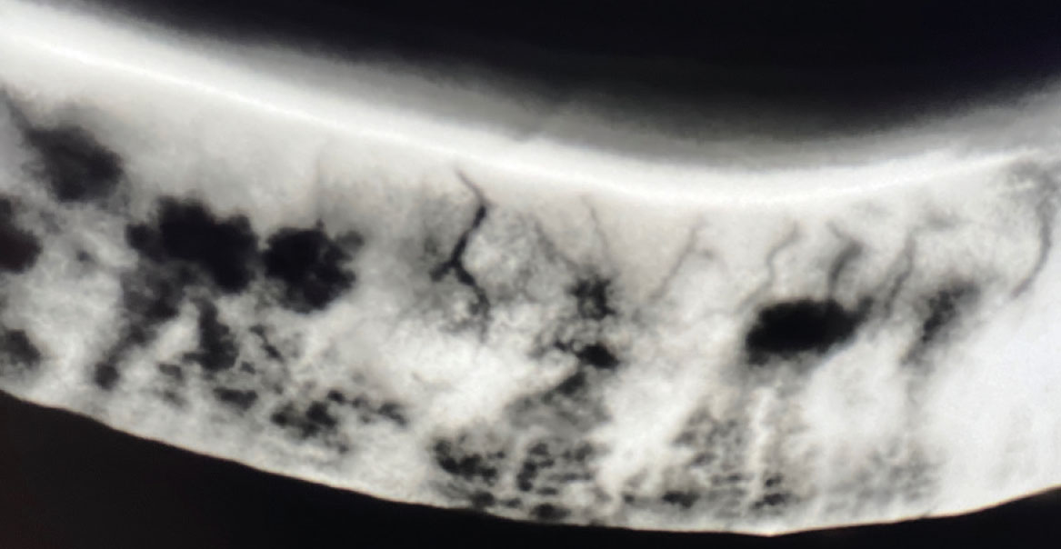 Fig. 10 Meibografia inferiore con retro-illuminazione mediante C.diag che evidenzia presenza di telengectasie.