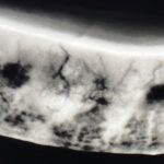 Fig. 11 Meibografia a retro-illuminazione mediante C.diag che evidenzia ghiandole Meibomio piene di mebo.