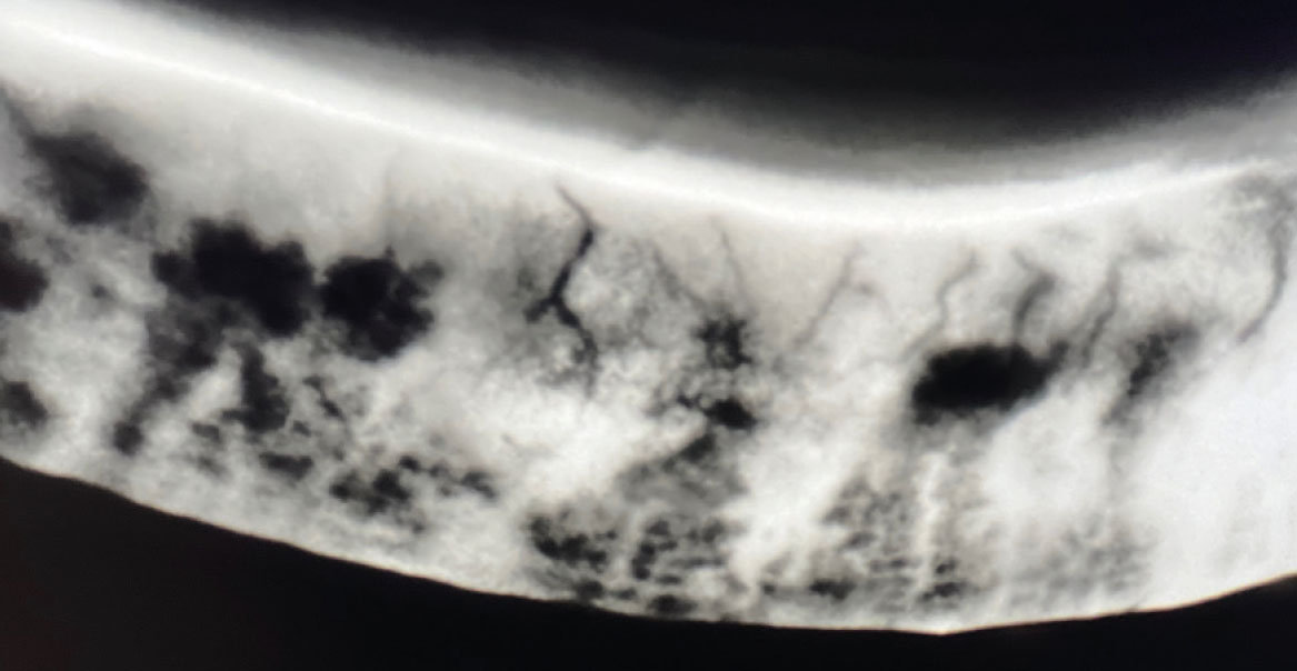 Fig. 11 Meibografia a retro-illuminazione mediante C.diag che evidenzia ghiandole Meibomio piene di mebo.