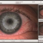 Fig. 12A Valutazione iperemia congiuntivale bulbare nasale e temporale mediante scala Jenvis attraverso il Keratograph.