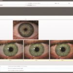 Fig. 12B Valutazione iperemia congiuntivale bulbare nasale e temporale mediante scala Jenvis attraverso il Keratograph.