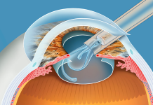 FANS per l’EMPO dopo chirurgia della cataratta/refrattiva: il ruolo del ketorolac
