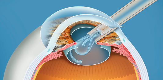 FANS per l’EMPO dopo chirurgia della cataratta/refrattiva: il ruolo del ketorolac