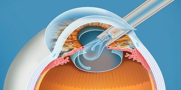 chirurgia-della-cataratta