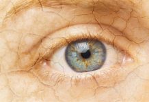 Dry eye