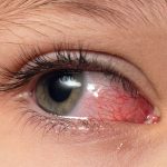 Closeup irritated infected red bloodshot eyes, conjunctivitis