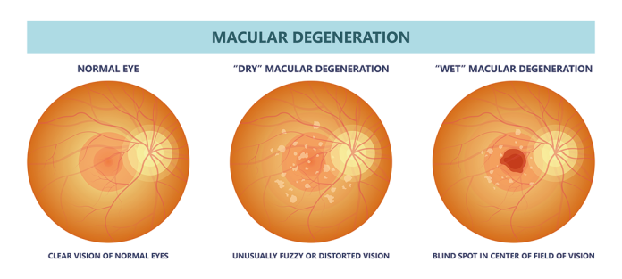 degenerazione-maculare