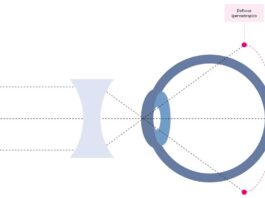 Nuove prospettive ed evidenze sulla gestione della progressione miopica