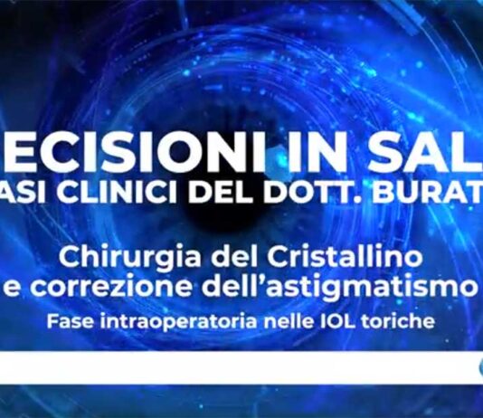 Chirurgia del cristallino e correzione dell’astigmatismo – fase intraoperatoria nelle IOL toriche