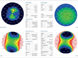 Chirurgia del cristallino: come programmare al meglio la correzione dell’astigmatismo
