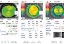 Rotazione IOL-T a 15 giorni dall’intervento