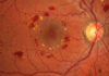 Retinopatia diabetica non proliferante severa: gestione clinica e strategie terapeutiche retinopatia diabetica