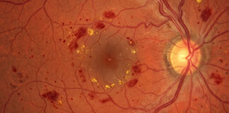 retinopatia diabetica