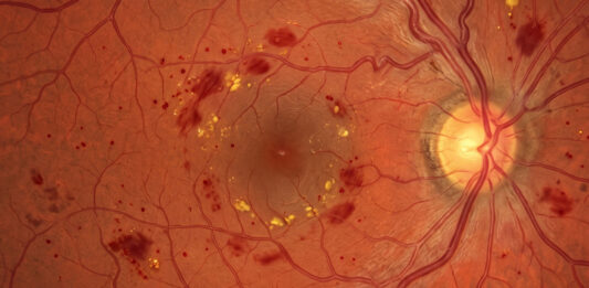 Retinopatia diabetica non proliferante severa: gestione clinica e strategie terapeutiche retinopatia diabetica