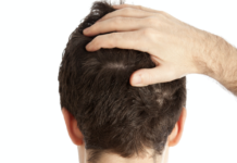 Forfora e dermatite seborroica: aspetto clinico, diagnosi e trattamento dermatite seborroica