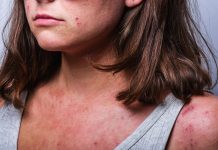 Soluzioni naturali per la pelle infiammata