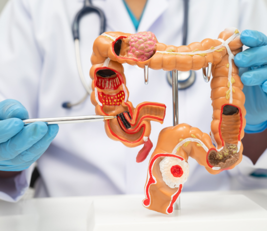 Marzo è il mese dedicato alla sensibilizzazione per il tumore del colon retto (anche in farmacia) Giornata Mondiale del tumore del colon retto