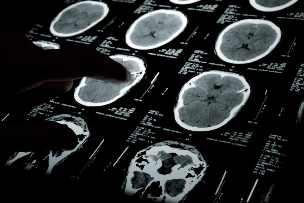 Il neuroblastoma rappresenta il 10% delle neoplasie pediatriche