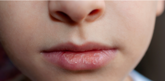 Bocca secca: quando è più di un fastidio Bocca secca: il ruolo del farmacista