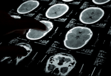 Tecnologia per anticipare l’Alzheimer diagnosi precoce Alzheimer test digitale