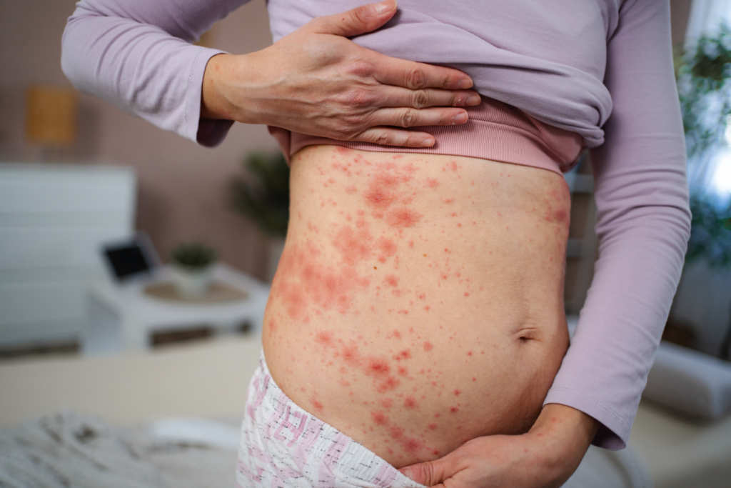 Il prurito intenso è il sintomo cardine ed è spesso causa di una marcata compromissione del sonno e del benessere psicofisico, specie nei bambini.